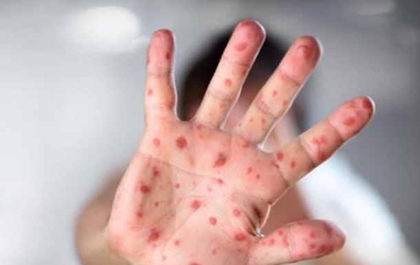 Эпидемия кори в Запорожье: количество заболевших более 300