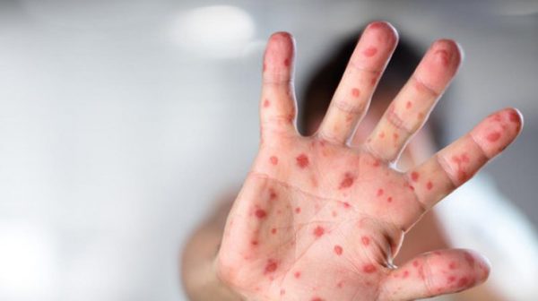За последнюю неделю в Запорожской области вирусной инфекцией заболели 6 человек