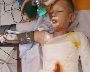 В Днепре дети облили бензином и подожгли 8-летнего мальчика