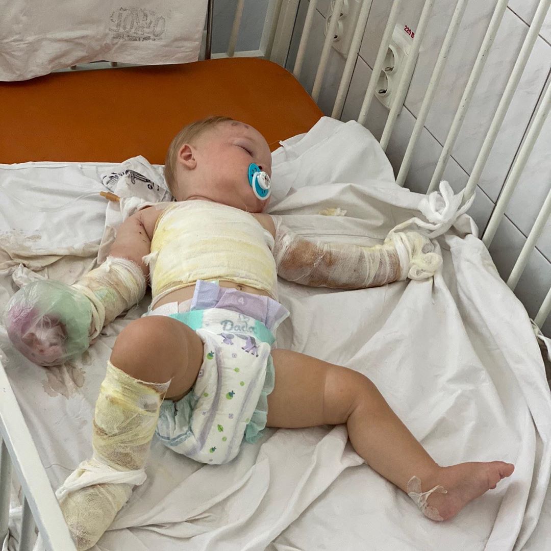 В Запорожье 8-месячный ребенок обварился кипятком