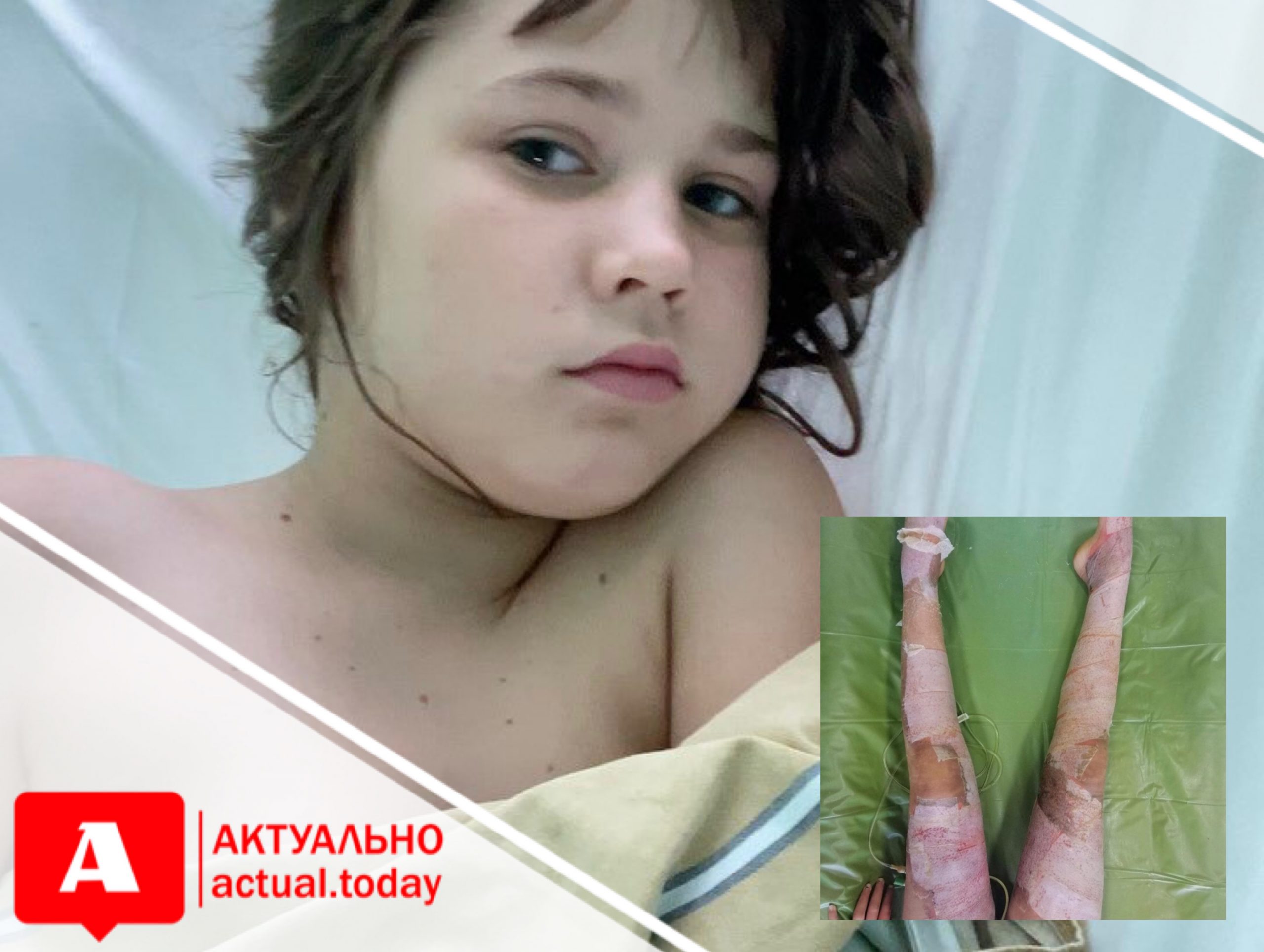 Запорожцев просят помочь 11-летней девочке, которая получила серьёзные ожоги, помогая маме с консервацией (ФОТО)
